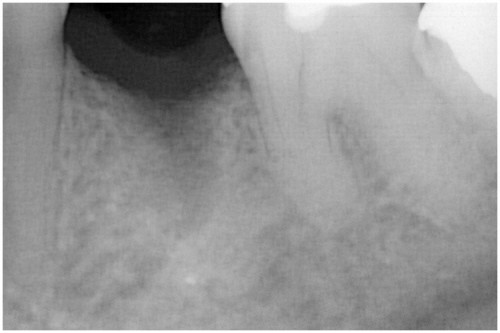 松本４　抜歯後2ヶ月後